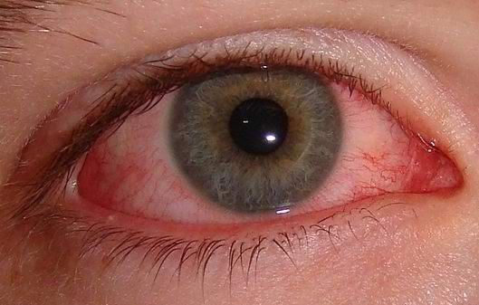 التهاب العين