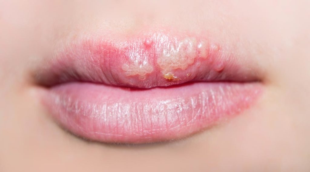 أسباب ظهور فطريات الفم في الشتاء و طرق الوقاية منها