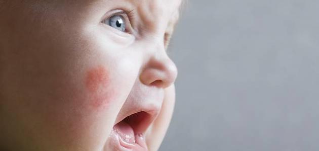 حساسية الجلد لدى الأطفال